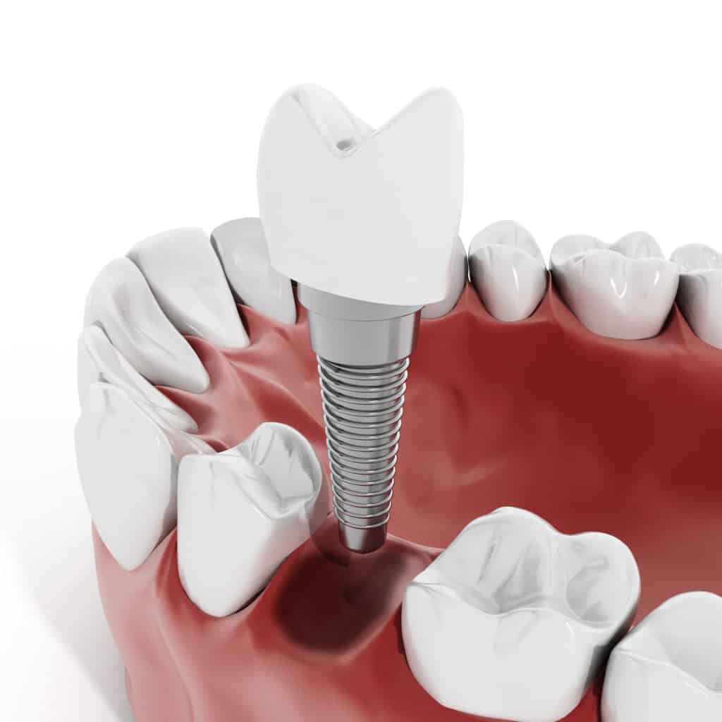 Dental Implants