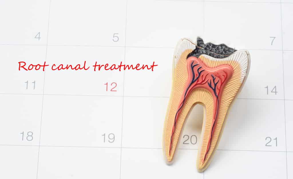 Root Canal Treatment