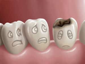 what are tooth decay and cavities