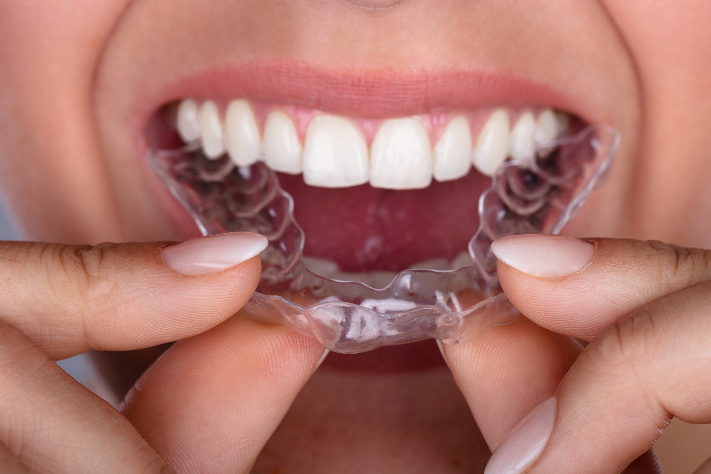 Are ClearCorrect® Aligners Really Better than Braces? Austin, Tx